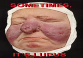 It's Not Lupus