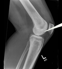 I Took an Arrow in the Knee